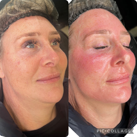 5 sessions Skin Tightening Facial